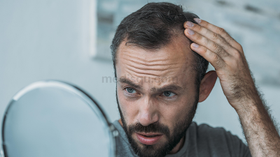Tips Menumbuhkan Rambut Rontok Pada Pria